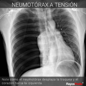 neumotorax a tension en radiografia rayos x

